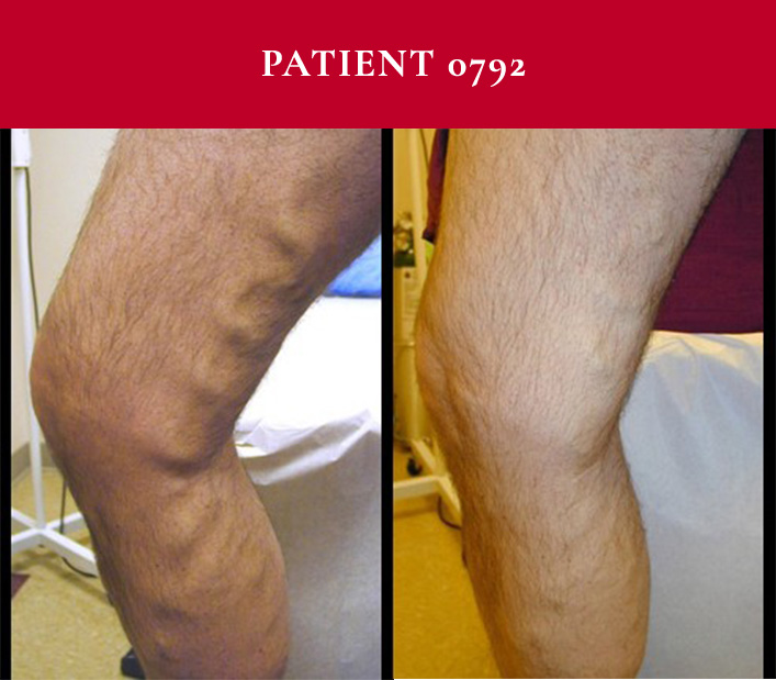 Southwest Vein and Leg Before and After Patient 0792