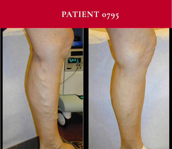 Southwest Vein and Leg Before and After Patient 0795