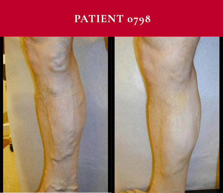 Southwest Vein and Leg Before and After Patient 0798