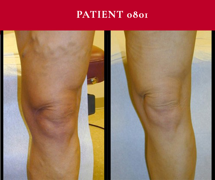 Southwest Vein and Leg Before and After Patient 0801