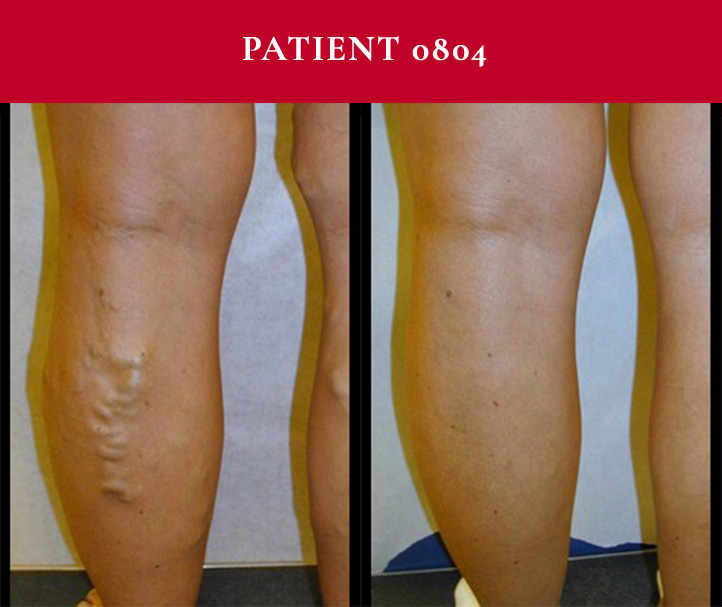 Southwest Vein and Leg Before and After Patient 0804