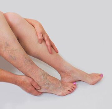 Southwest Vein and Leg Radiofrequency Ablation