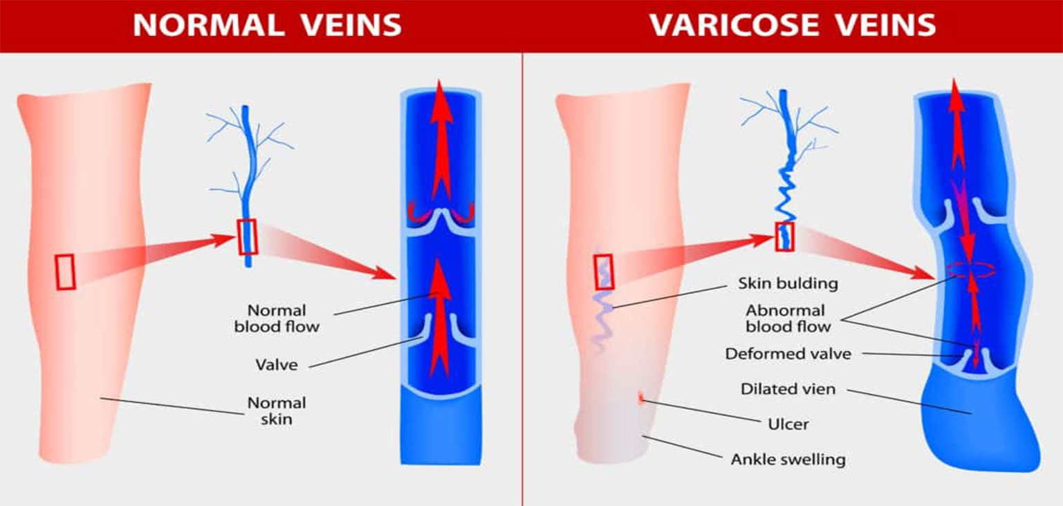 Southwest Vein and Leg Vein Disease Normal Veins VS Varicose Veins